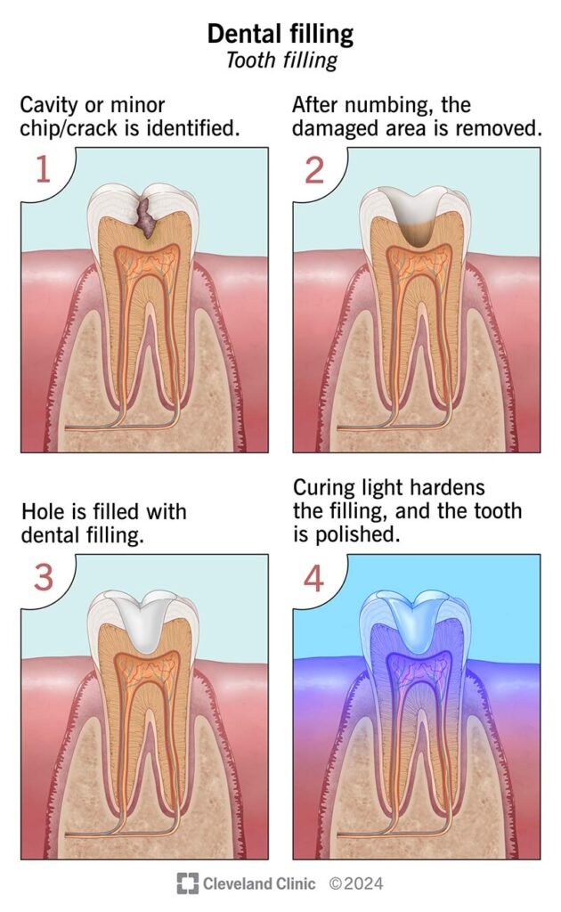 Cavity fillings 
